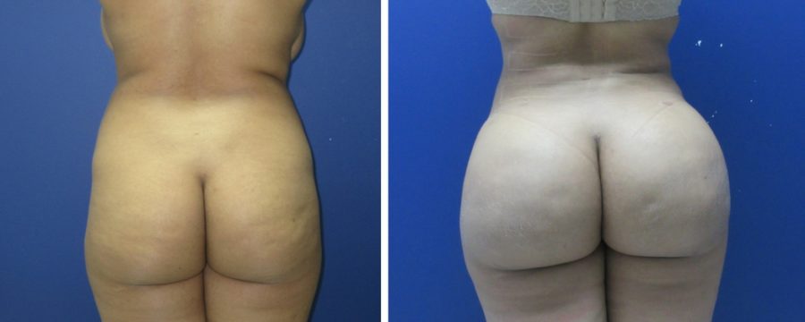 Brazilian Butt Lift | Plastic Surgery Miami FL