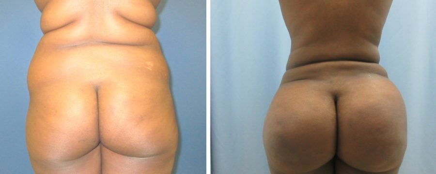 Brazilian Butt Lift | Plastic Surgery Miami FL