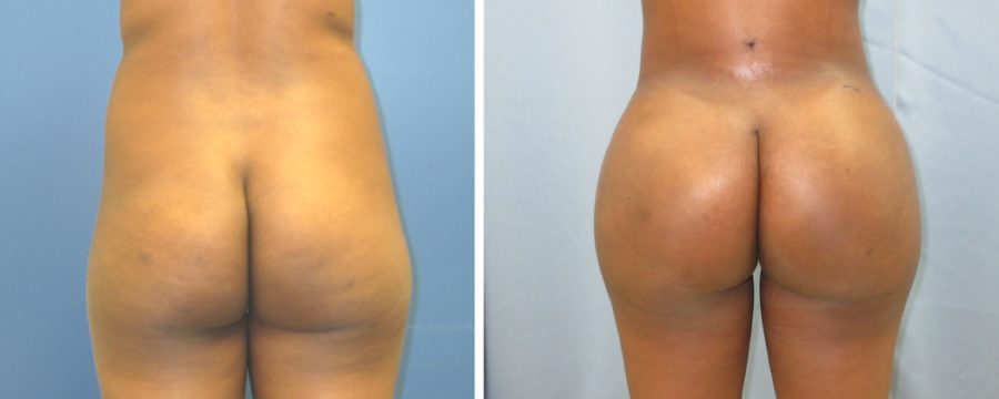 Brazilian Butt Lift | Plastic Surgery Miami FL