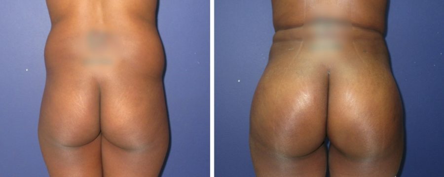 Brazilian Butt Lift | Plastic Surgery Miami FL