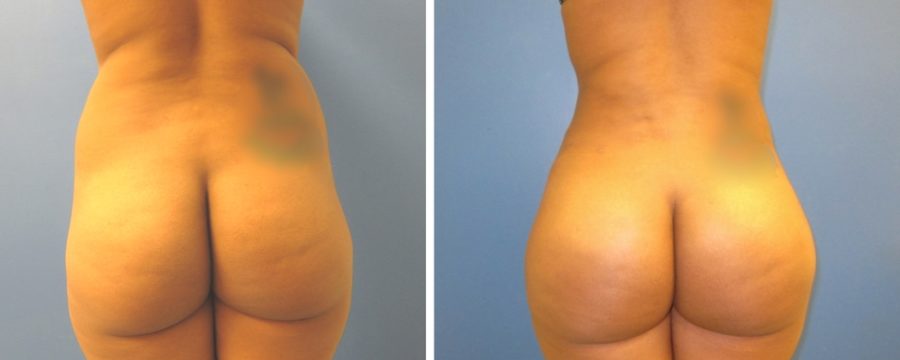 Brazilian Butt Lift | Plastic Surgery Miami FL